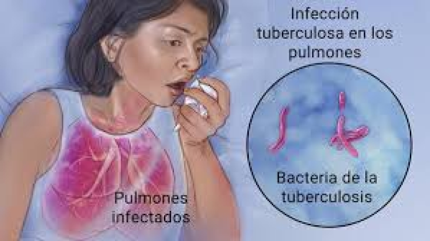 Cuauhtémoc registra 16 casos de tuberculosis, 6 muertes