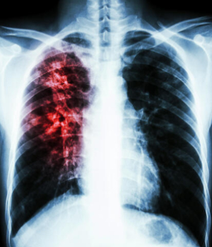 Suman m&aacute;s de 6 mil casos de neumon&iacute;a y bronconeumon&iacute;a en 2025