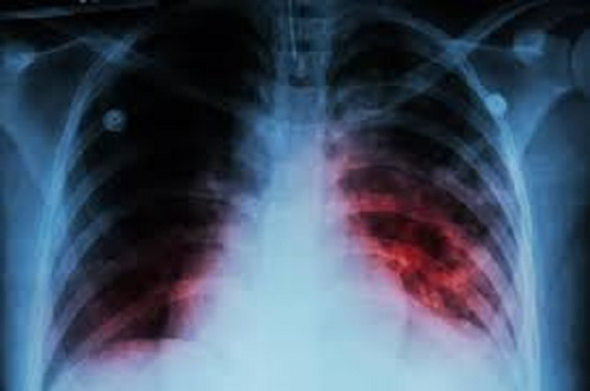 Suman mas de 400 casos de tuberculosis y 50 muertes